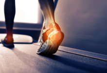 Heel Spurs vs. Plantar Fasciitis: Understanding the Difference to Get the Right Treatment