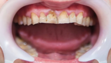 All About Dental Fluorosis: Causes, Symptoms, and Prevention