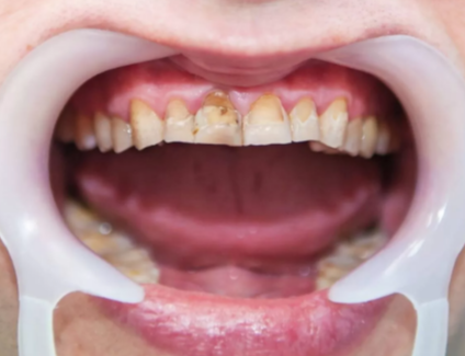 All About Dental Fluorosis: Causes, Symptoms, and Prevention